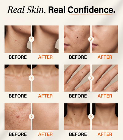 Skin tags Removal Pen