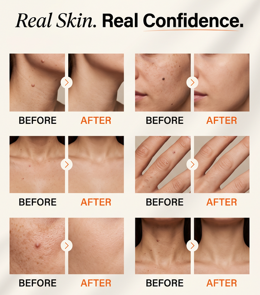Skin tags Removal Pen